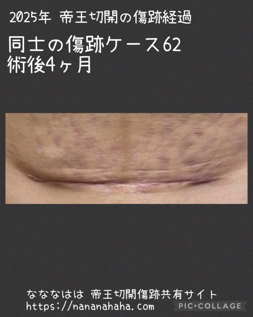 同士の傷跡62・4ヶ月