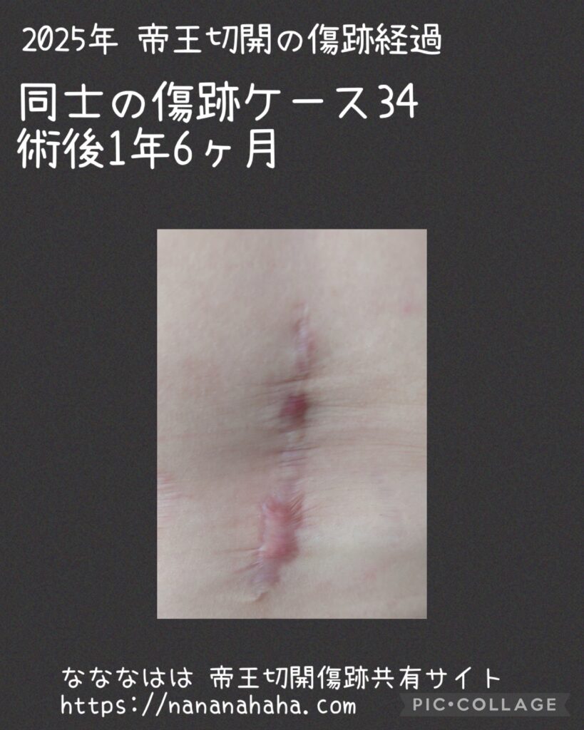 同士の傷跡34・1年6ヶ月