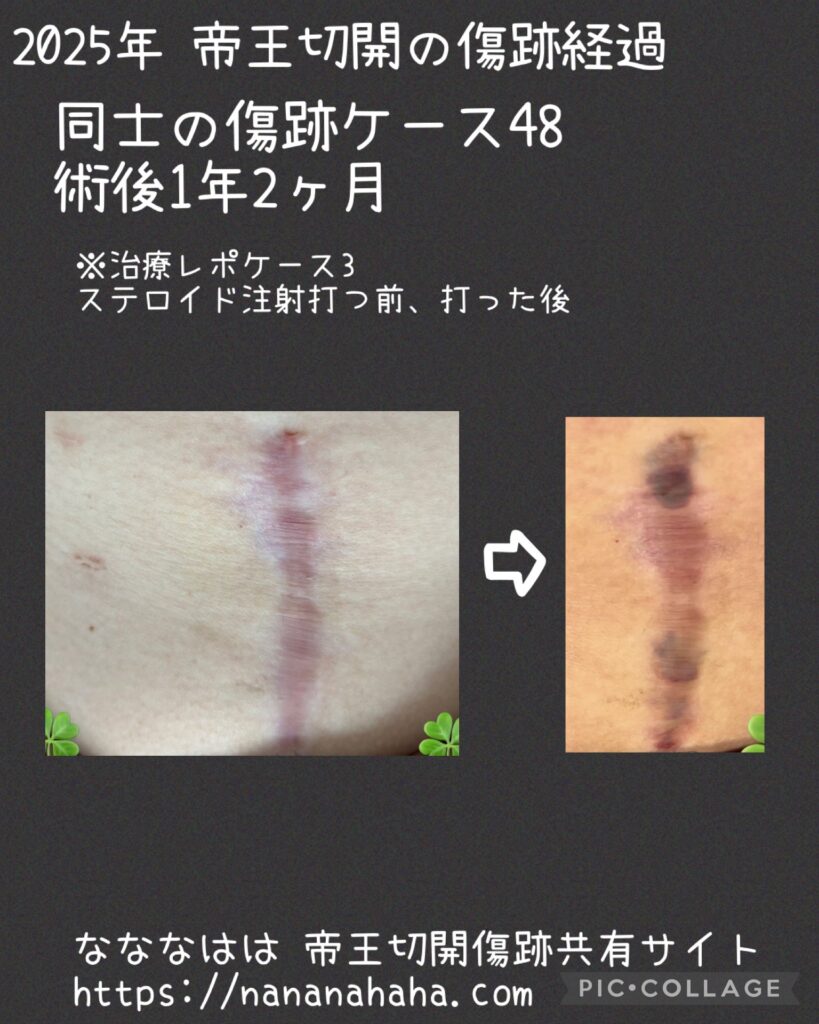 治療ケース3・1年2ヶ月(同士48)注射直後