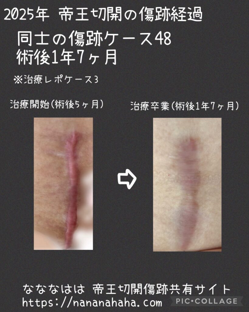 治療ケース3・1年7ヶ月(同士48)治療卒業