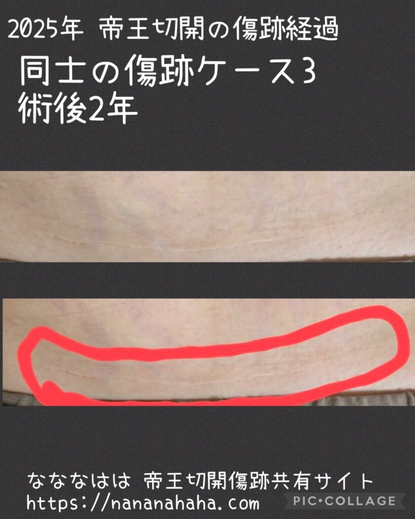 同士の傷跡3・2年