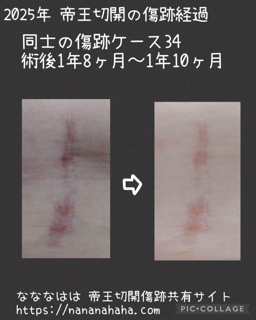同士の傷跡34・1年8ヶ月~1年10ヶ月