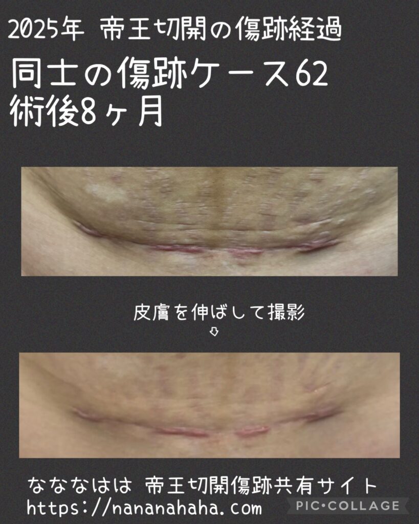 同士の傷跡62・8ヶ月
