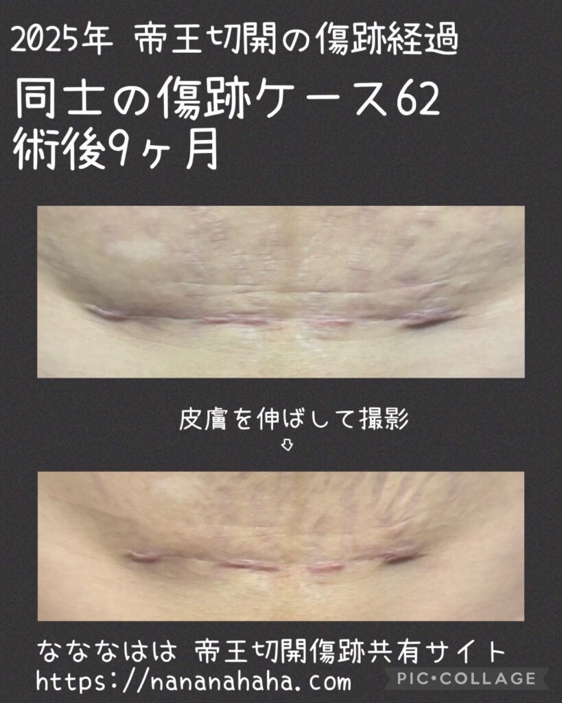 同士の傷跡62・9ヶ月