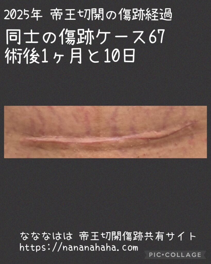 同士の傷跡67・術後1ヶ月