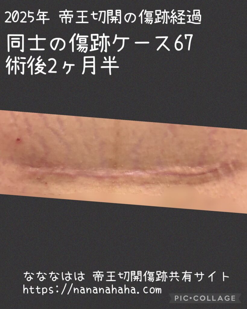 同士の傷跡67・術後2ヶ月半