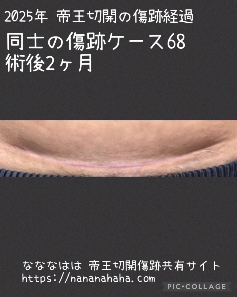 同士の傷跡68・術後2ヶ月