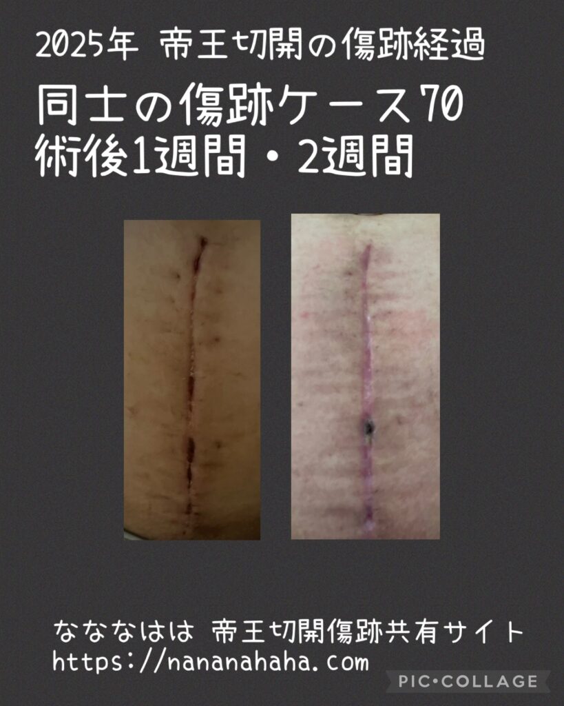 同士の傷跡70・術後1～2週間