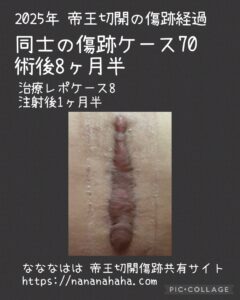 同士の傷跡70・術後8ヶ月半(注射後1ヶ月半)