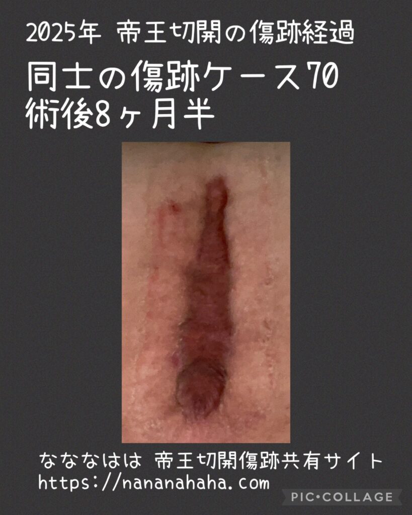 同士の傷跡70・術後8ヶ月半