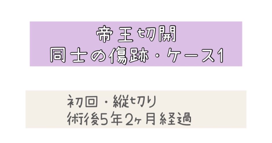 帝王切開の傷跡・ケース1