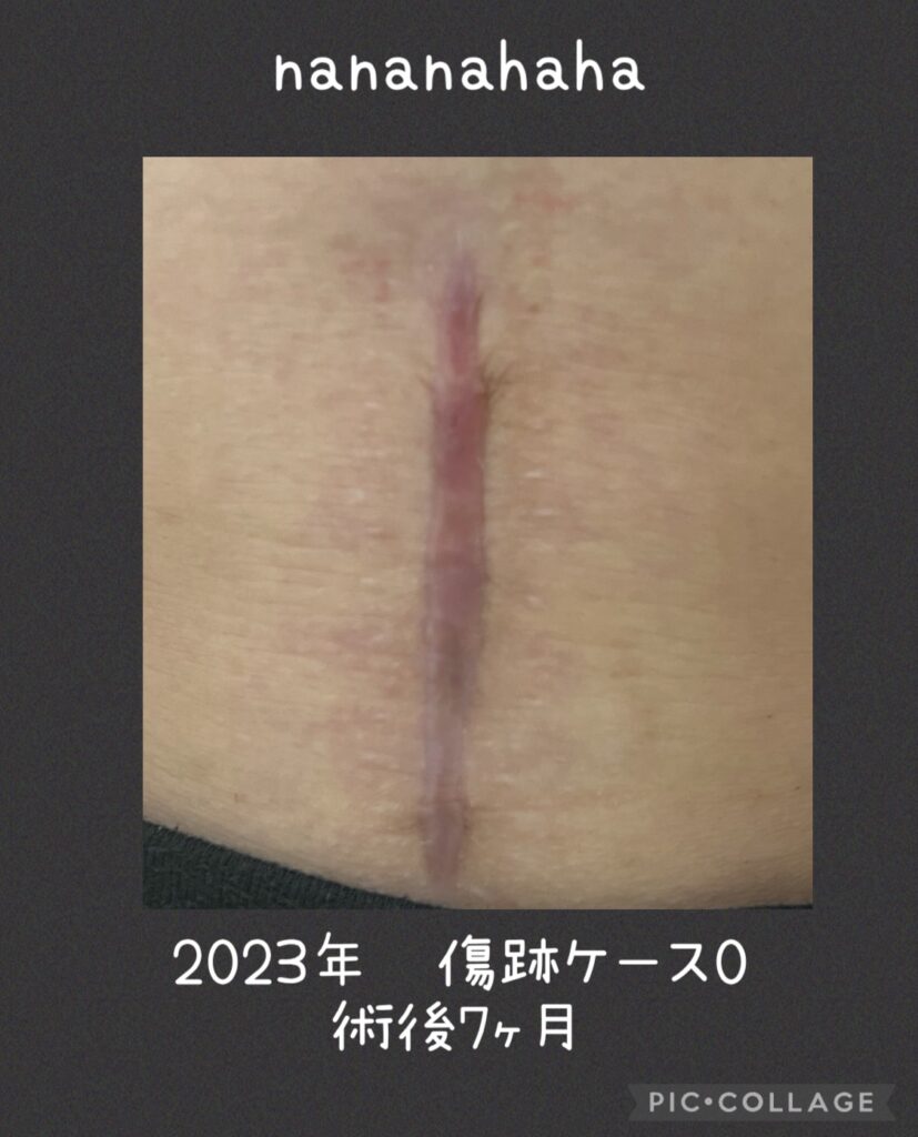 帝王切開の傷跡 経過⑥術後7ヶ月