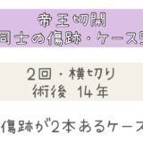 同士の傷跡～ケース⑤ 術後14年経過