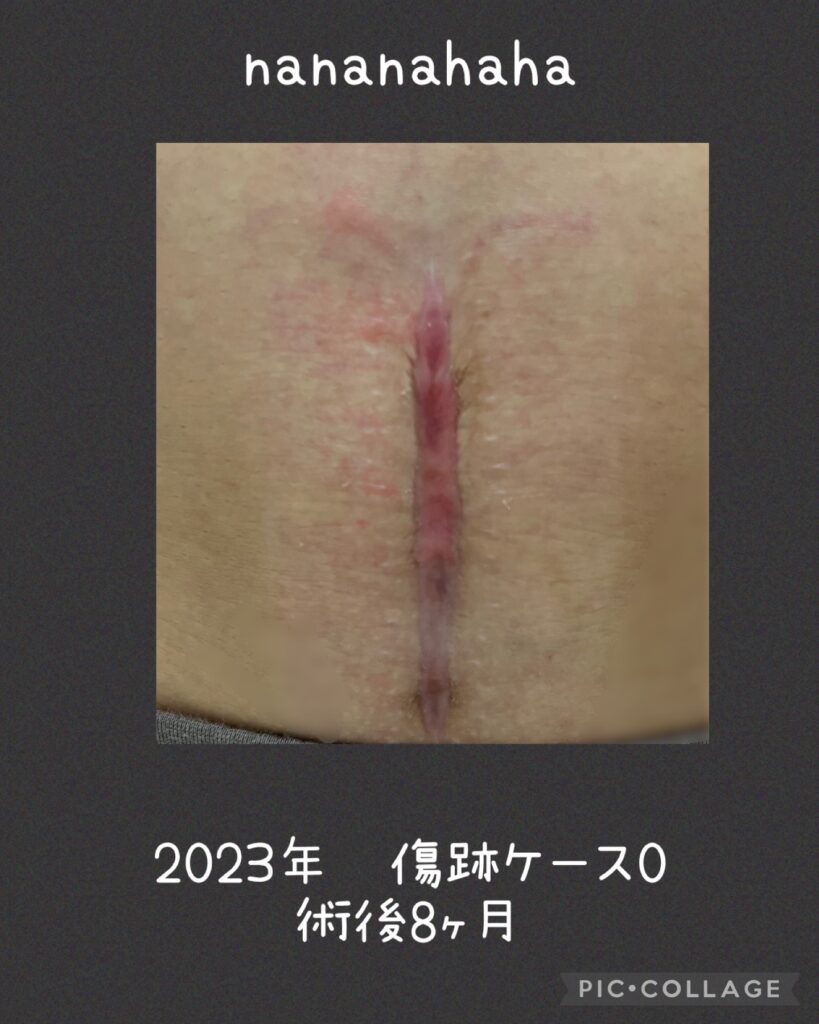帝王切開の傷跡経過⑦8ヶ月