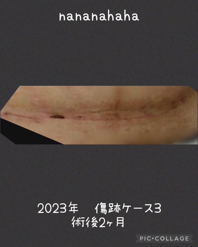 同士の傷跡ケース3・2ヶ月