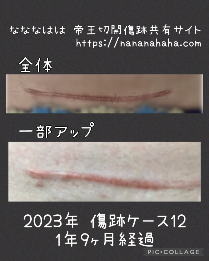 同士の傷跡ケース12・1年9ヶ月