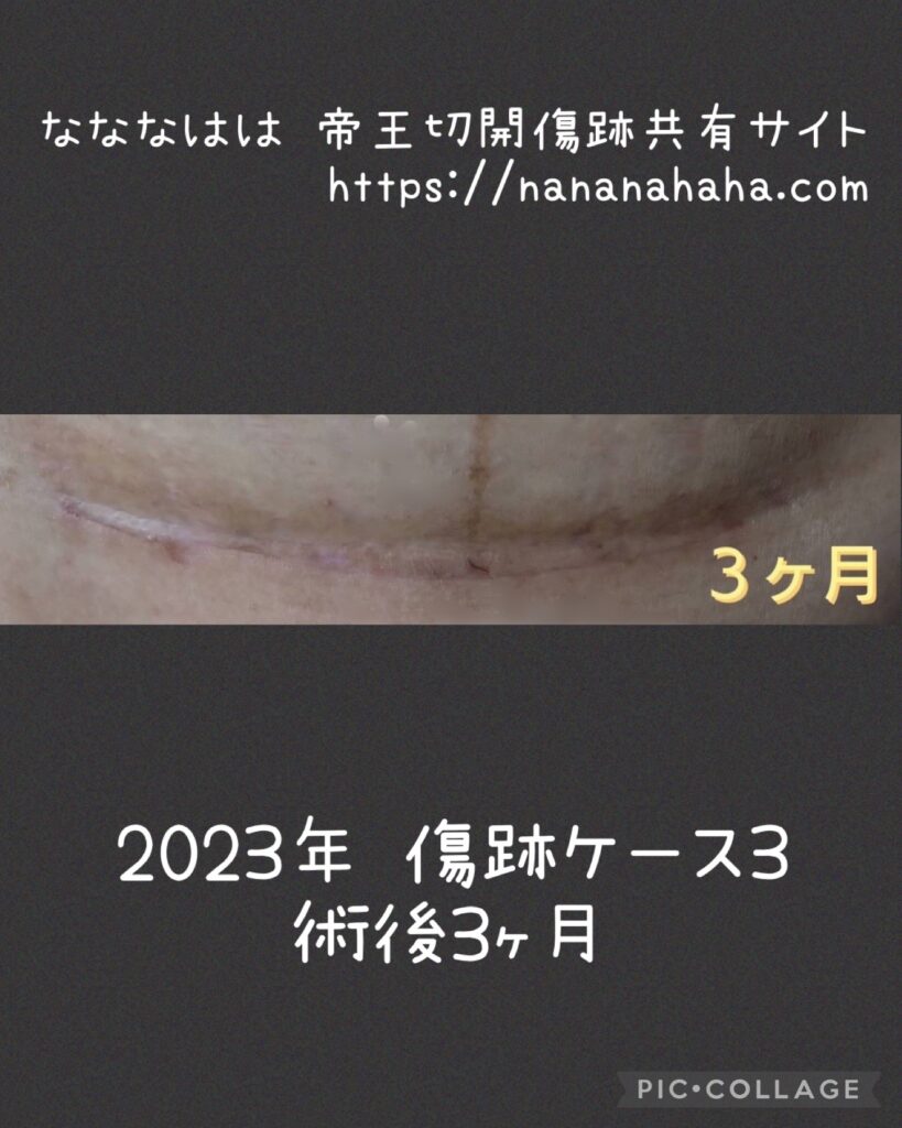 同士の傷跡ケース3・3ヶ月