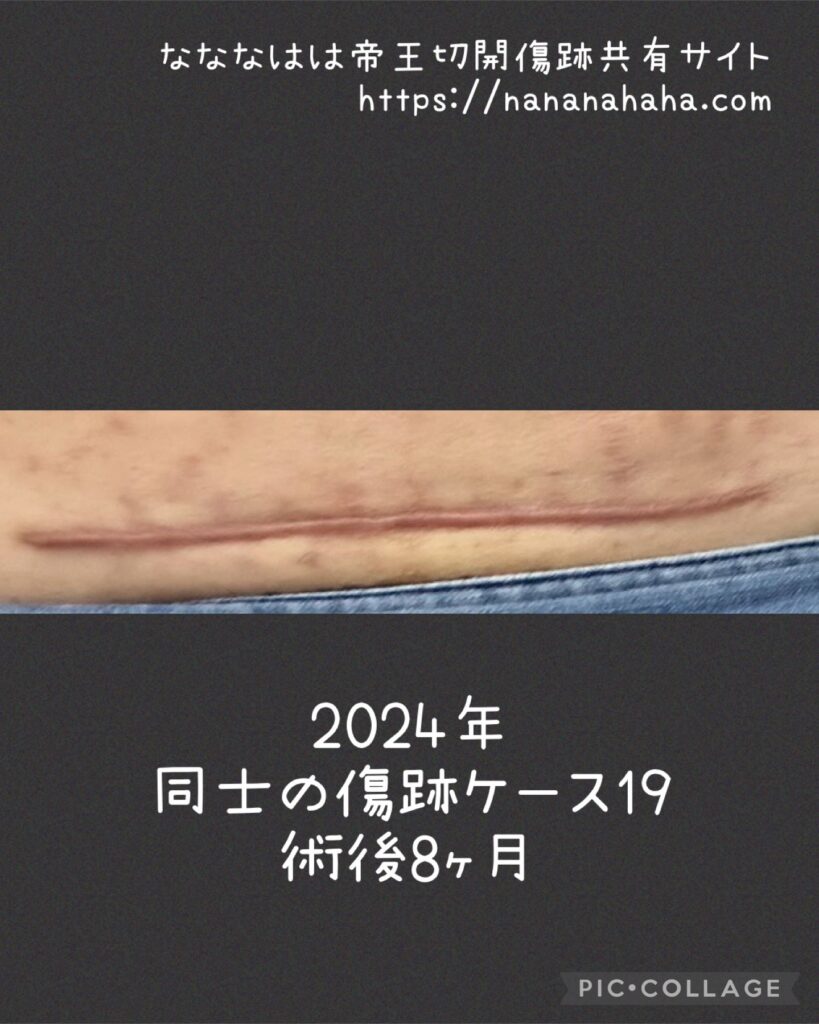 同士の傷跡ケース19・8ヶ月