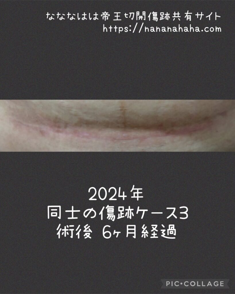 同士の傷跡3・6ヶ月