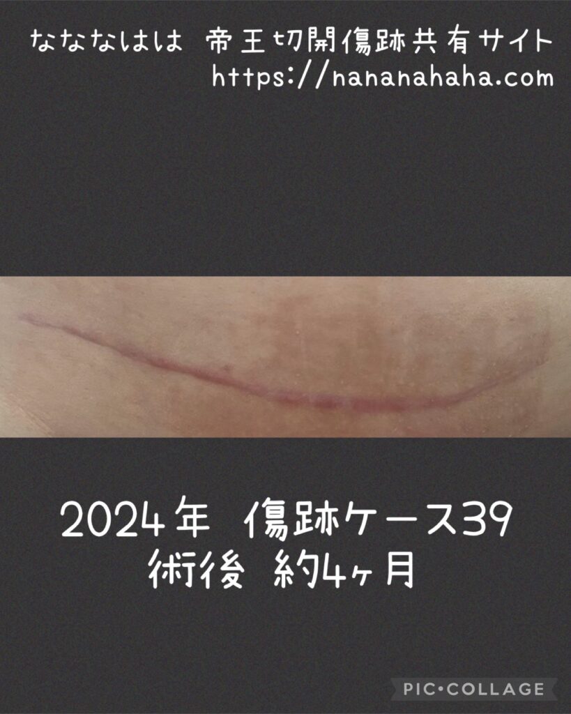 同士の傷跡39・4ヶ月