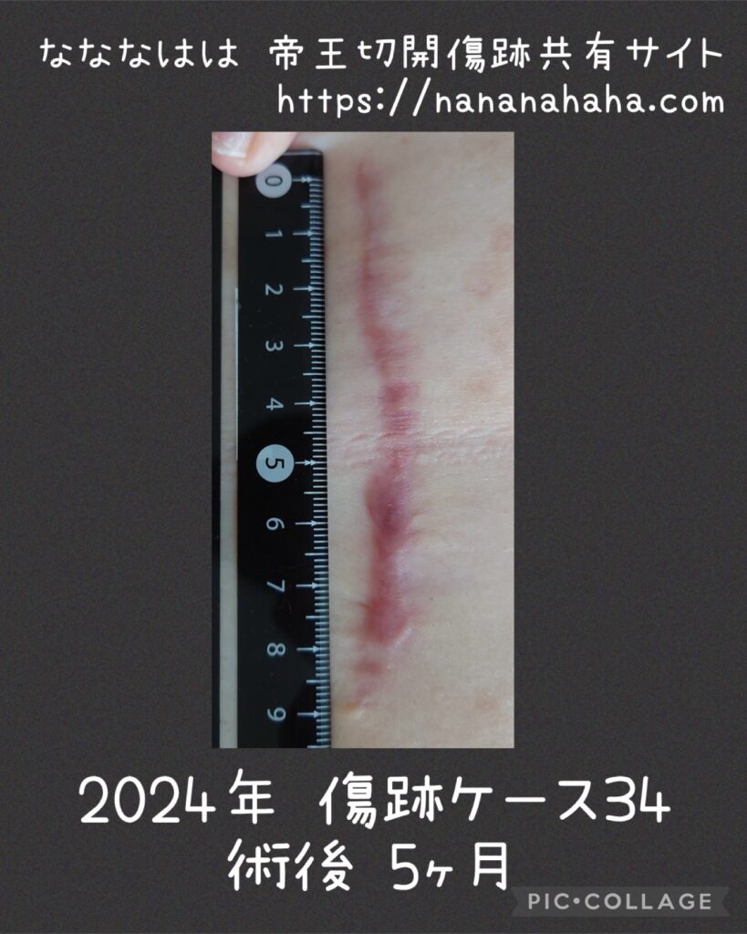 同士の傷跡34・5ヶ月