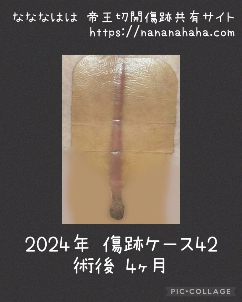 同士の傷跡42・4ヶ月