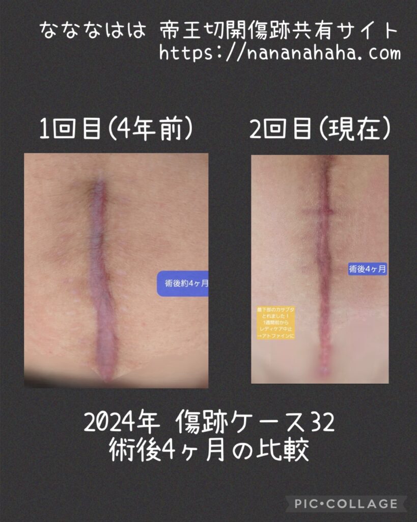 同士の傷跡32・1回目と2回目の4ヶ月比較
