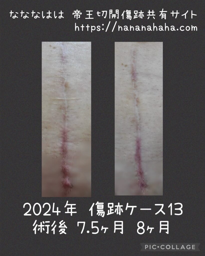 同士の傷跡13・7.5と8ヶ月
