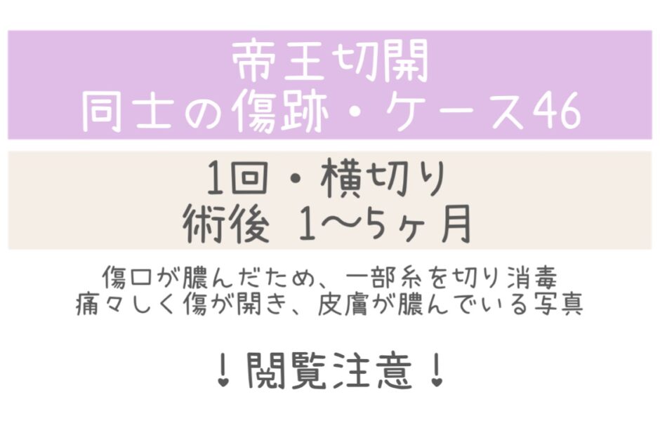 同士の傷跡46・1～5ヶ月