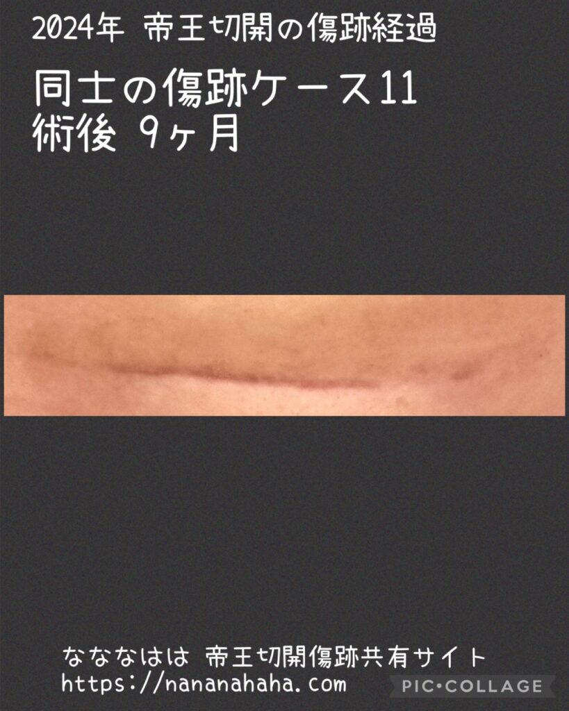 同士の傷跡11・9ヶ月