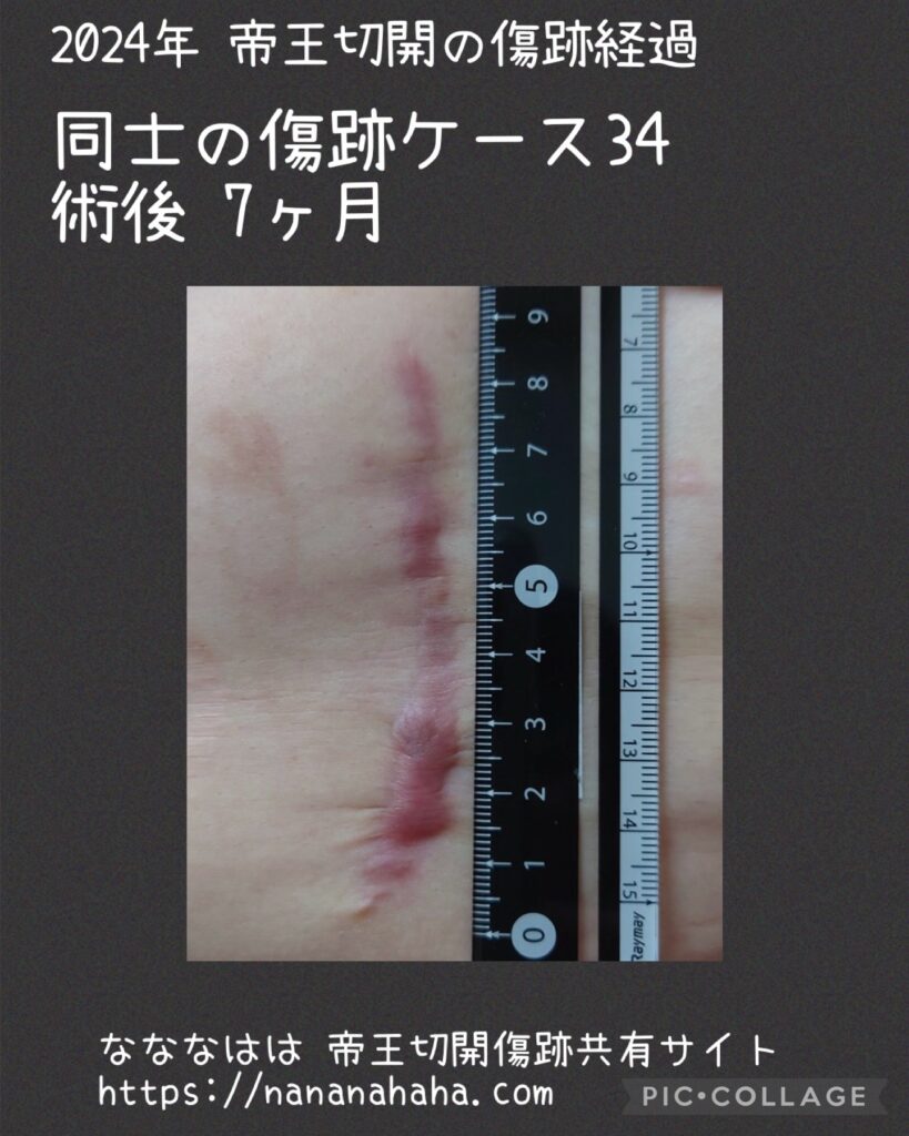 同士の傷跡34・7ヶ月