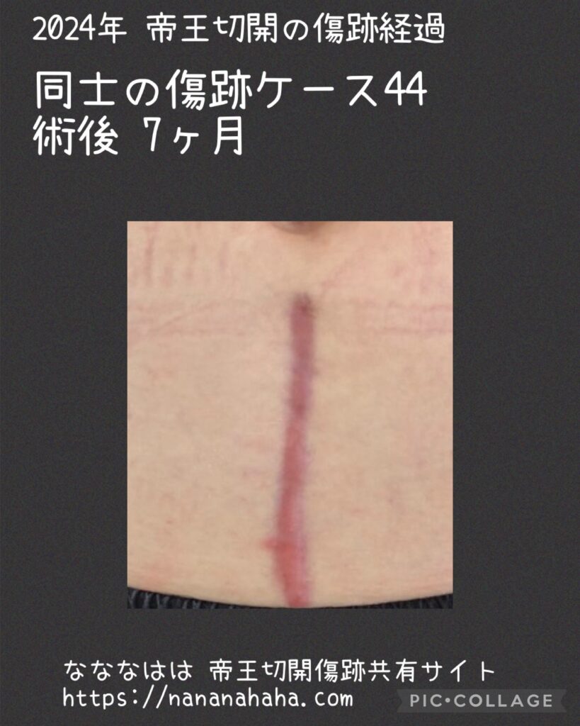 同士の傷跡44・7ヶ月