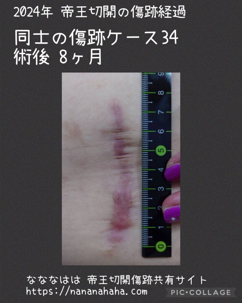 同士の傷跡34・8ヶ月