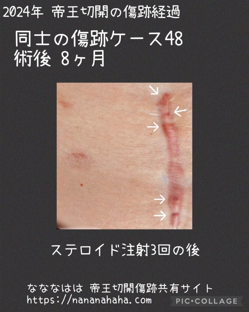 同士の傷跡48・8ヶ月注射3回