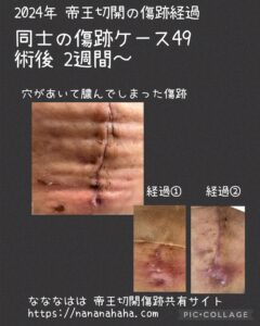 同士の傷跡49・2週間膿んだ経過