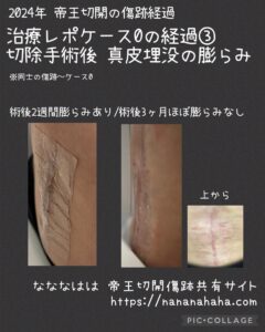 治療ケース0・経過③膨らみ横から