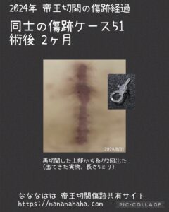 同士の傷跡51・2ヶ月(糸)