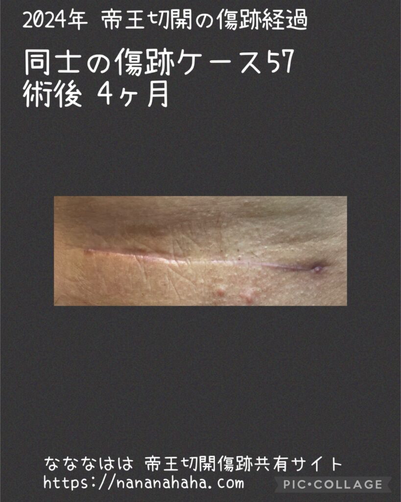 同士の傷跡57・4ヶ月