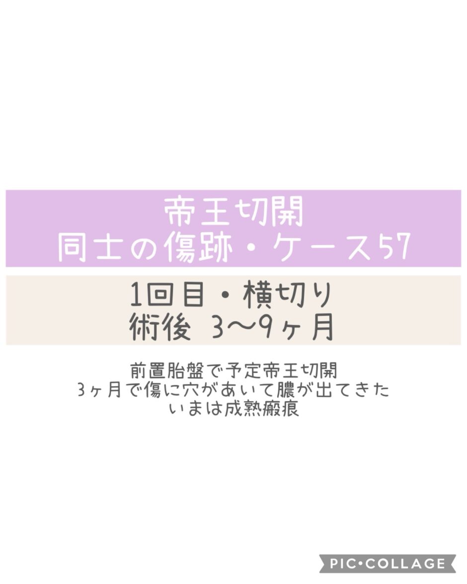 同士の傷跡57・3～9ヶ月