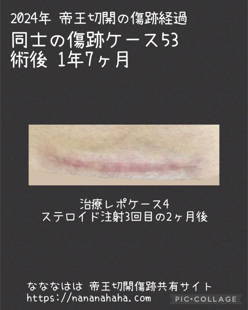 治療ケース4・1年7ヶ月注射3回