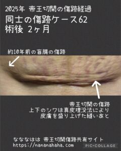 同士の傷跡62・術後2ヶ月