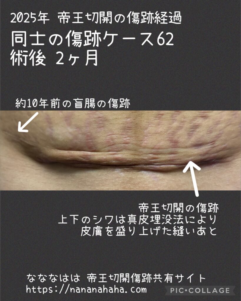 同士の傷跡62・術後2ヶ月