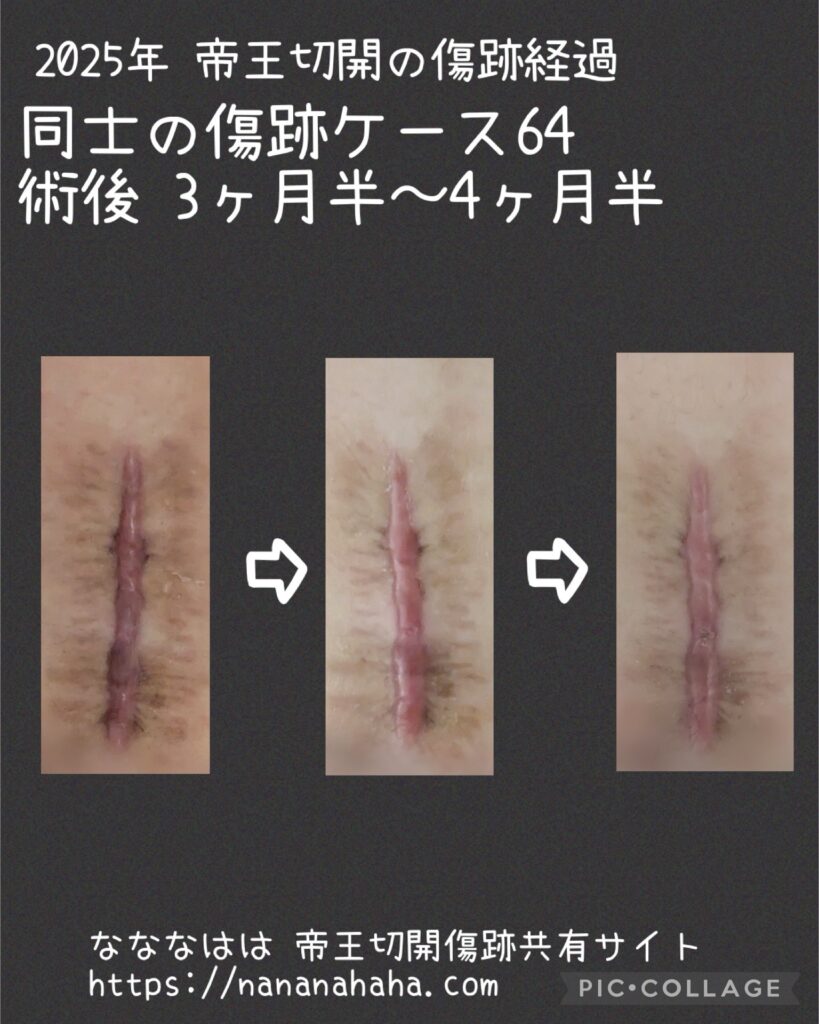 同士の傷跡64・3~4ヶ月