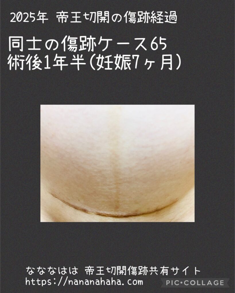 同士の傷跡65・1年半・妊娠7ヶ月