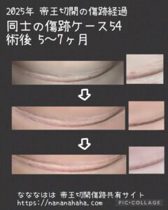 同士の傷跡54・5~7ヶ月