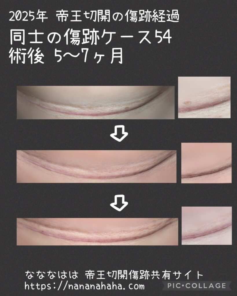 同士の傷跡54・5~7ヶ月
