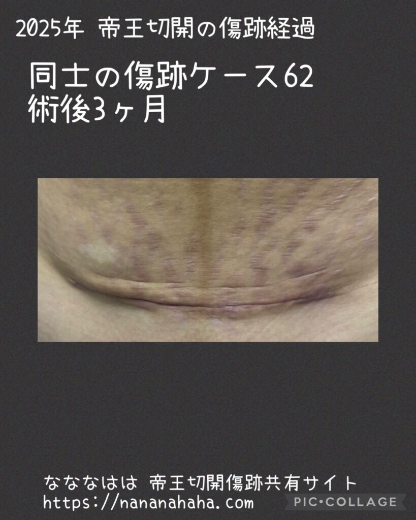 同士の傷跡62・3ヶ月