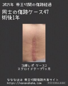 同士47・治療2・1年・テープ7ヶ月