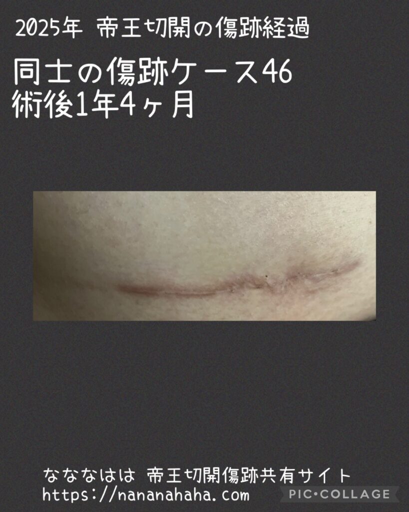 同士の傷跡46・1年4ヶ月