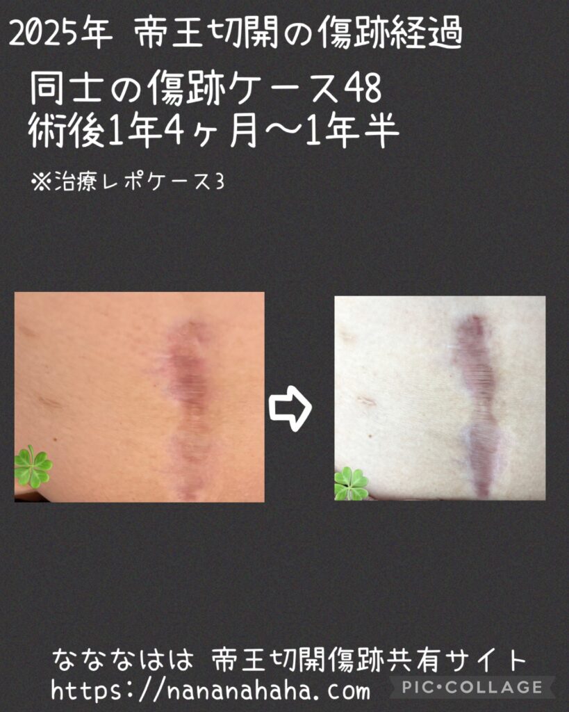 治療ケース3・1年4～6ヶ月(同士48)